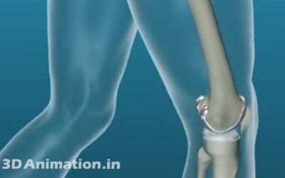3D Medical Animation Videos Total Knee Replacement