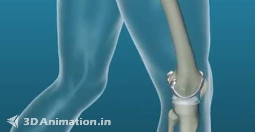 Medical Animation Videos Services By EFFE Animation | Total Knee  Replacement | EFFE Animation