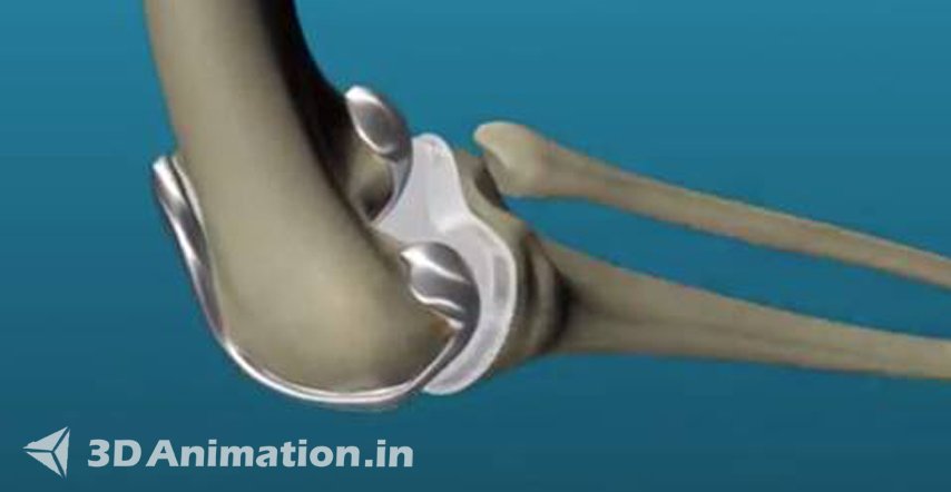 3D Animation & Rigging OF Medical Animation Videos