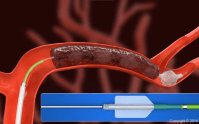 3D Medical eLearning Animation Videos – Neurovascular disease invasive therapeutics