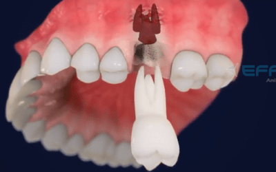3D Dental Implant Animated Video: Medical Animation Services