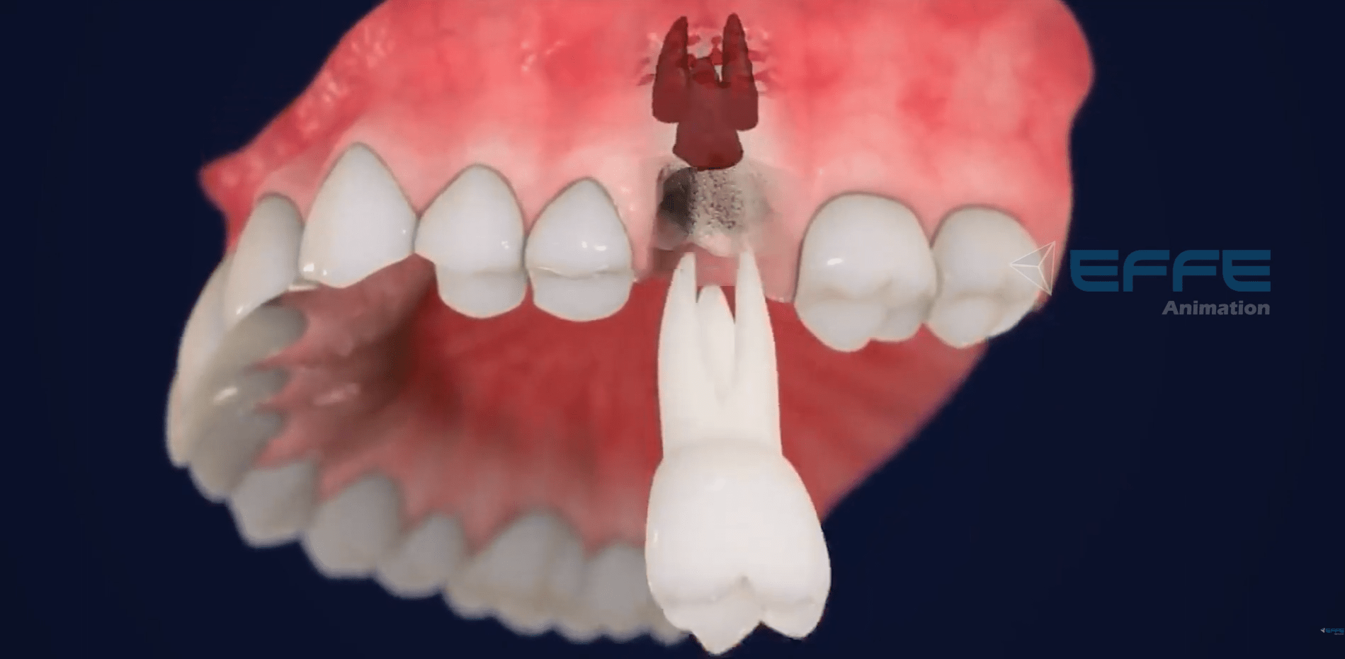 3D Dental Implant Animation