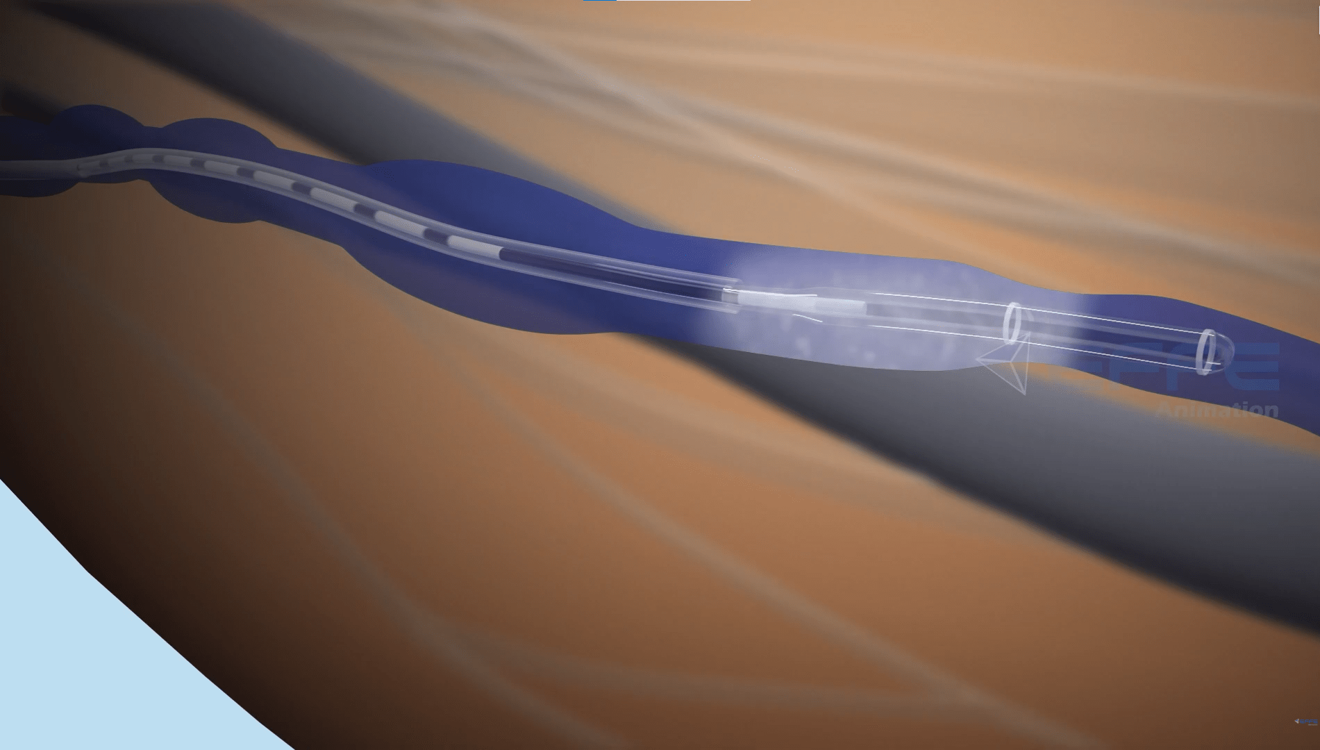 3D Endovenous Laser Ablation Animation Video