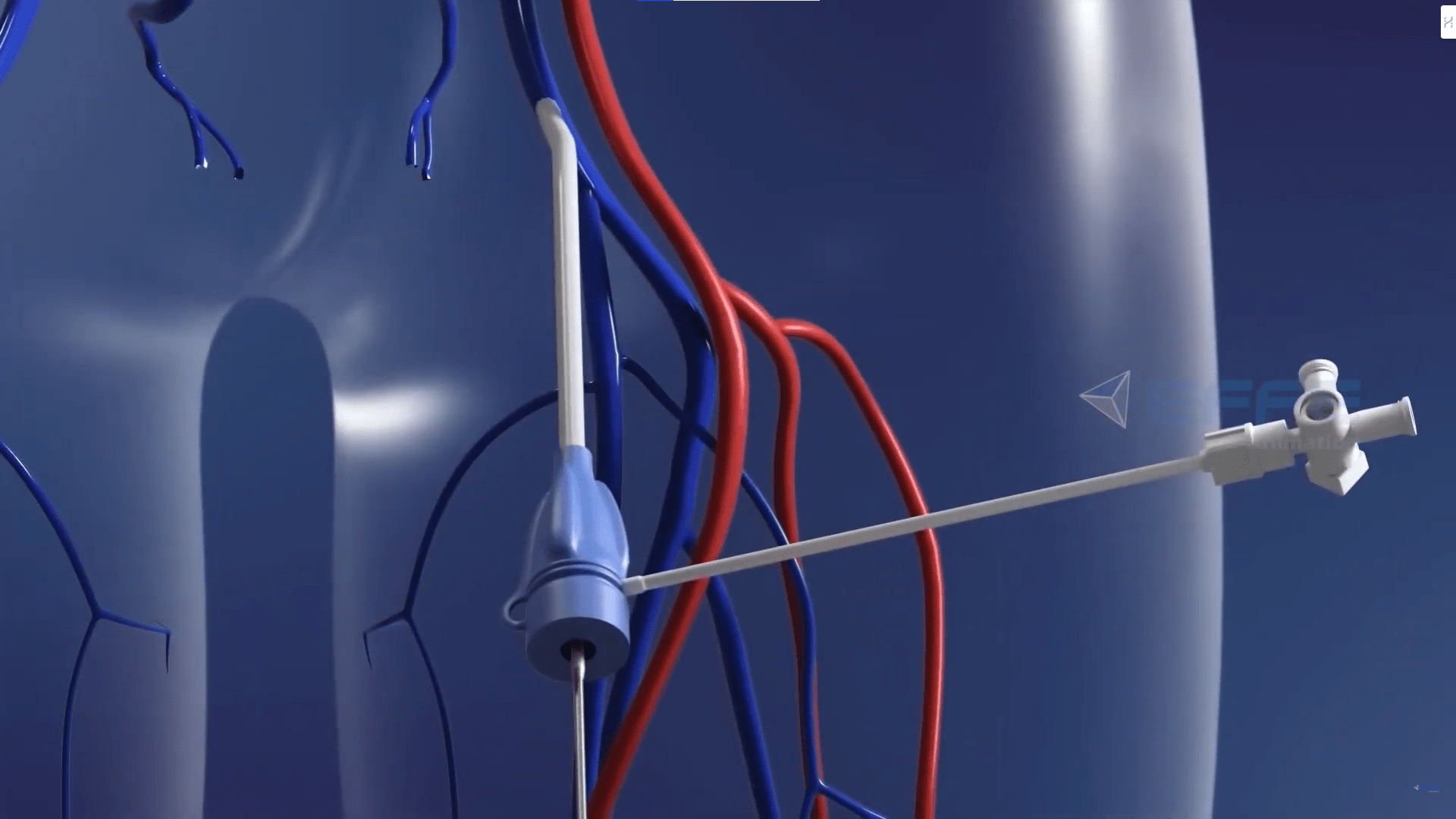 3D Animated Heart Transcatheter Video