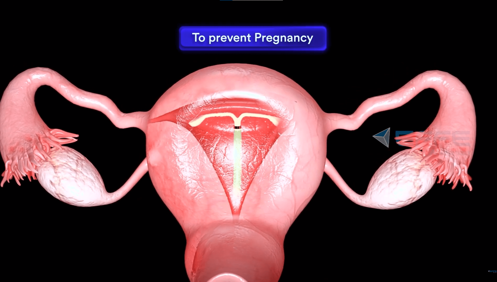 3D Intrauterine Devices Animation Video
