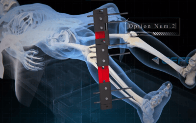 3D Animated Limb Lengthening Surgery Animation Video: 3D Medical Animation