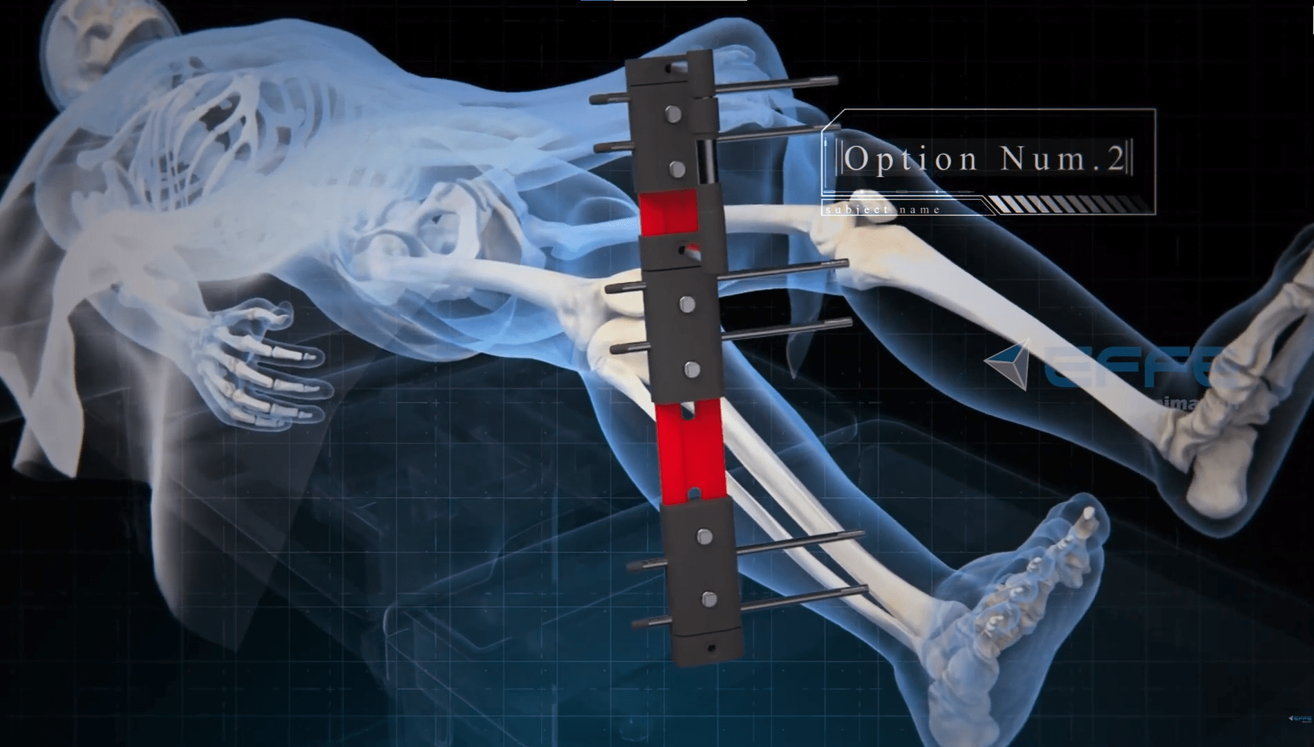 3D Limb Lengthening Surgery Animation Video