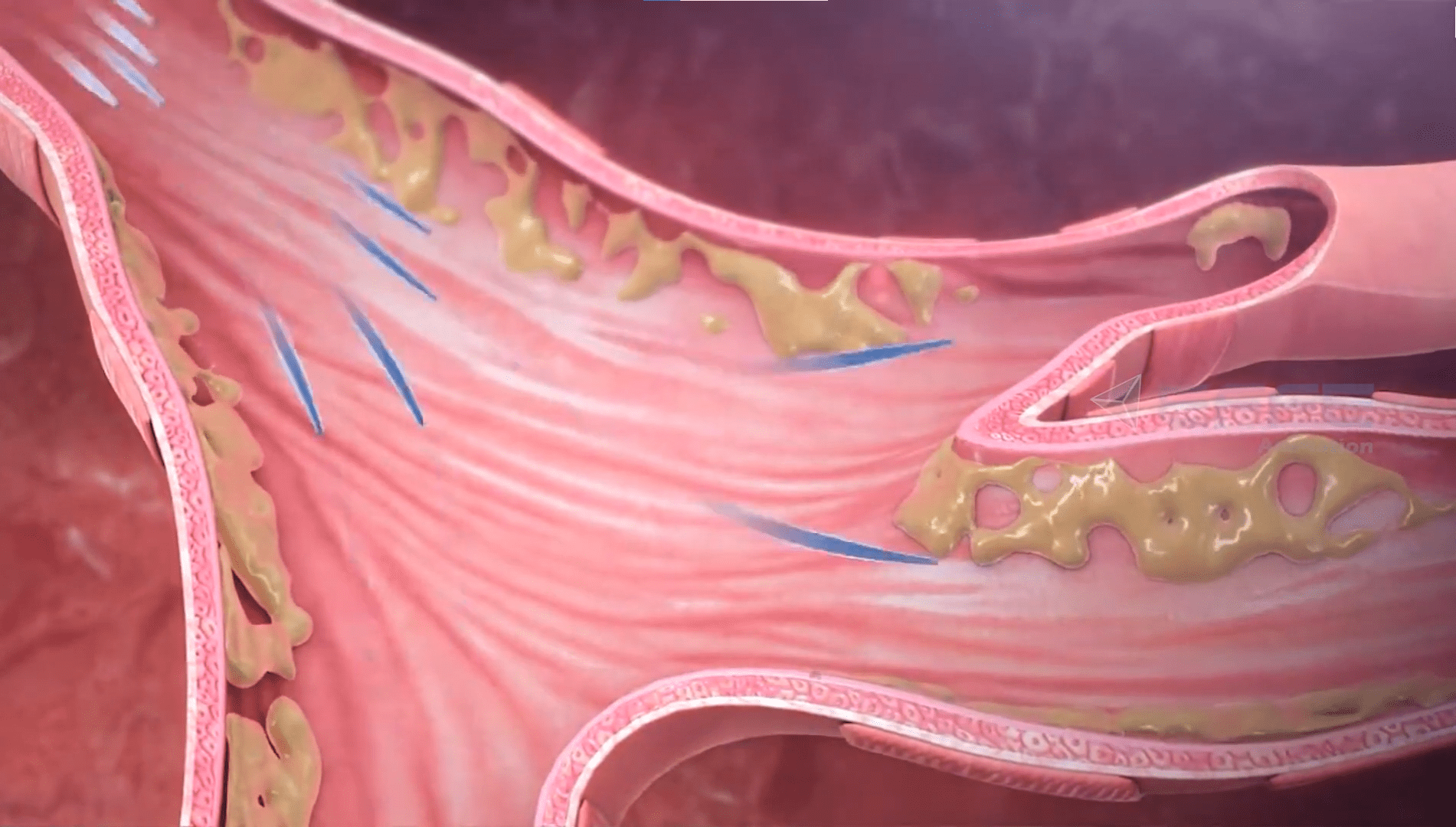 3D Pathology Animation Video