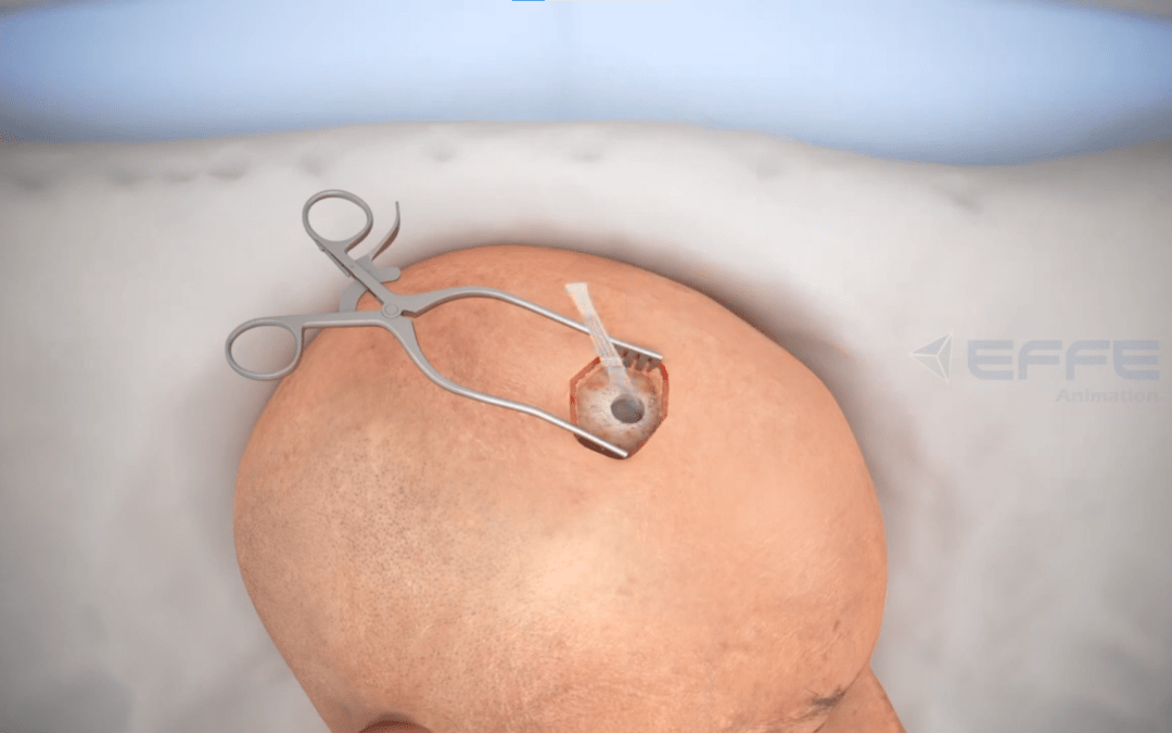3D Brain Surgery Animation Video: Medical Animated Video Services