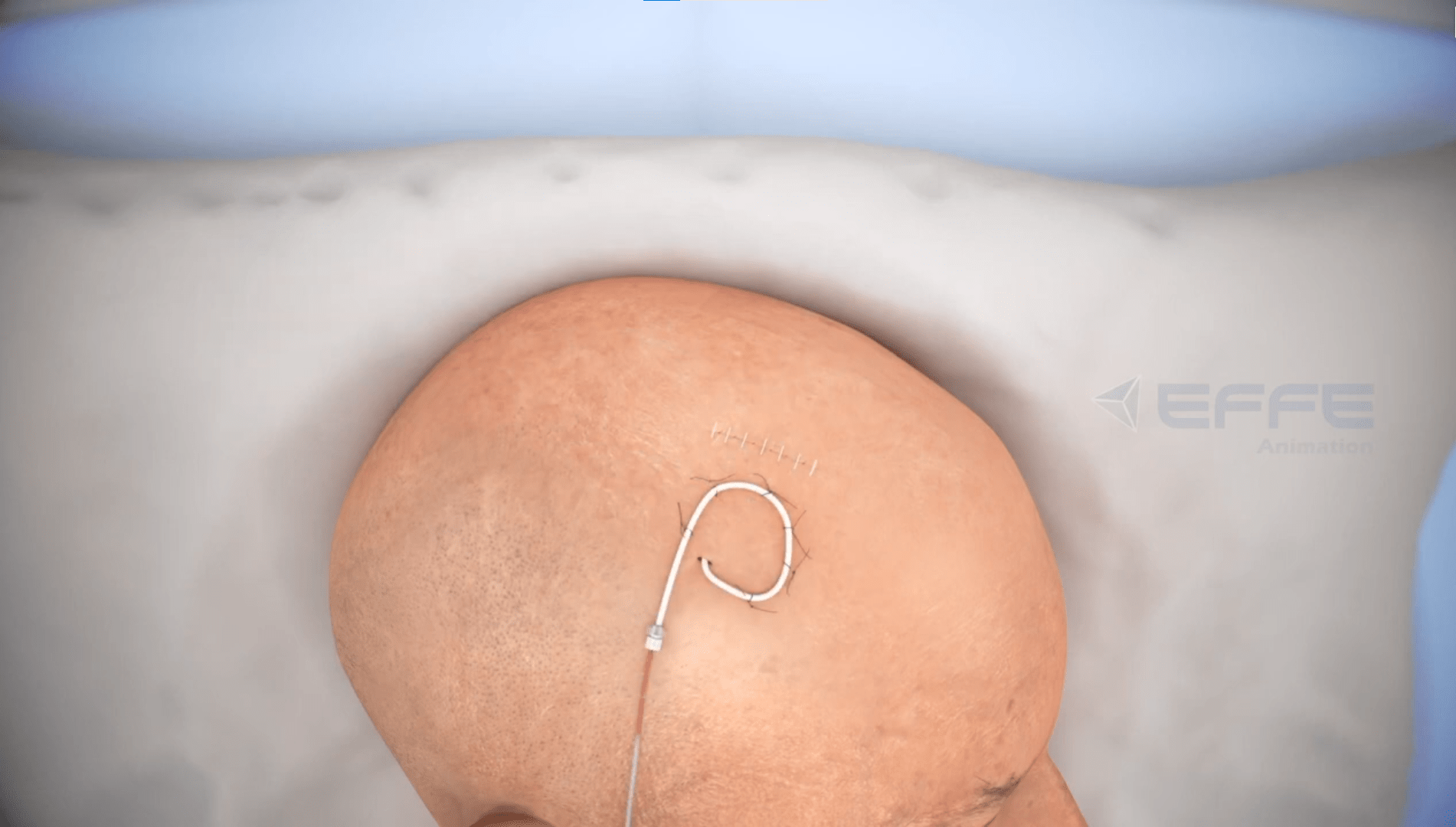 3D Brain Surgery Animation