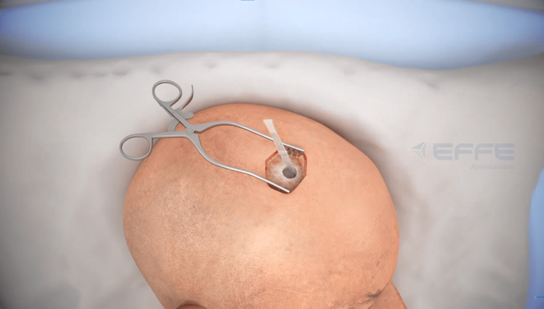 3D Brain Surgery Animation Video