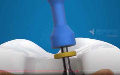 Root Canal Treatment Animation | 3D Dental Procedure Visualization