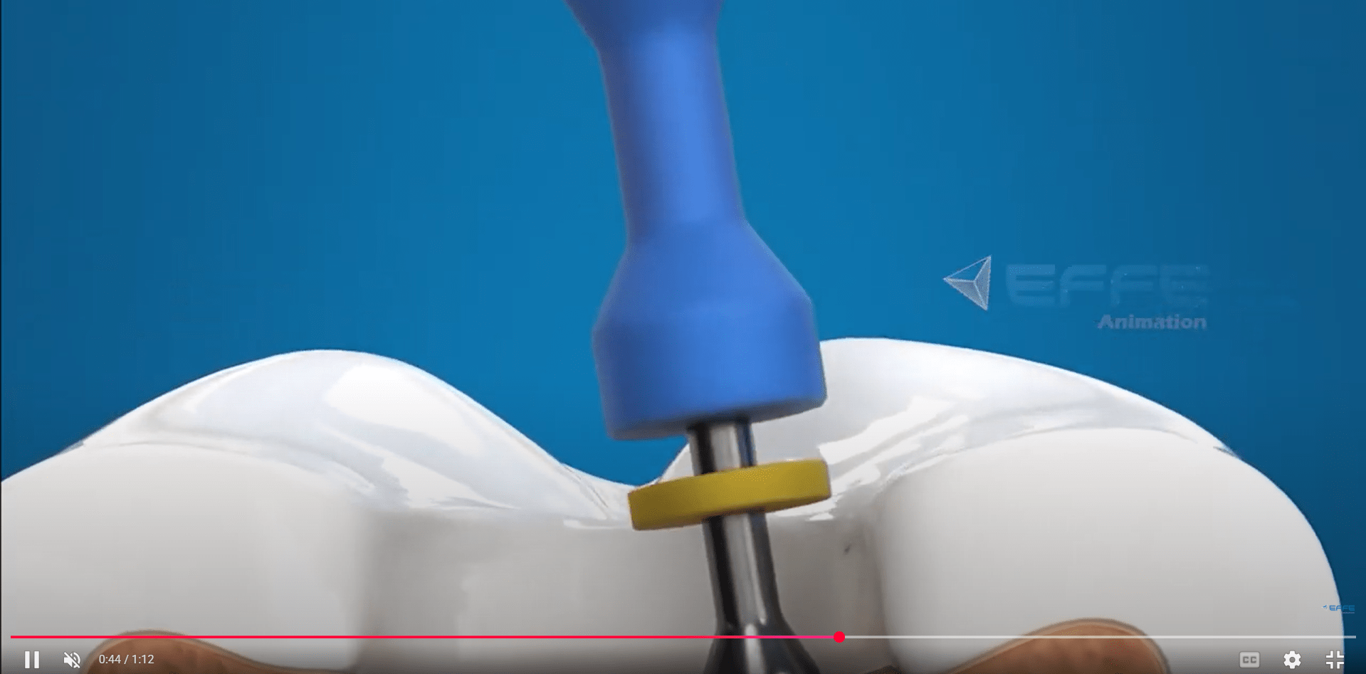 root canal treatment animation