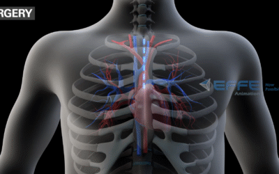 Heart Bypass Surgery – 3D Medical Animation