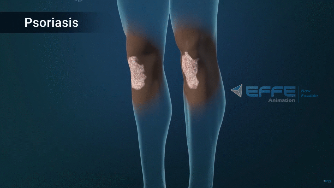 Dermatological Disease Mechanism Animation Services | 3D