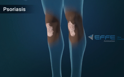 3D Mechanism of Disease Animation for Psoriasis Treatment