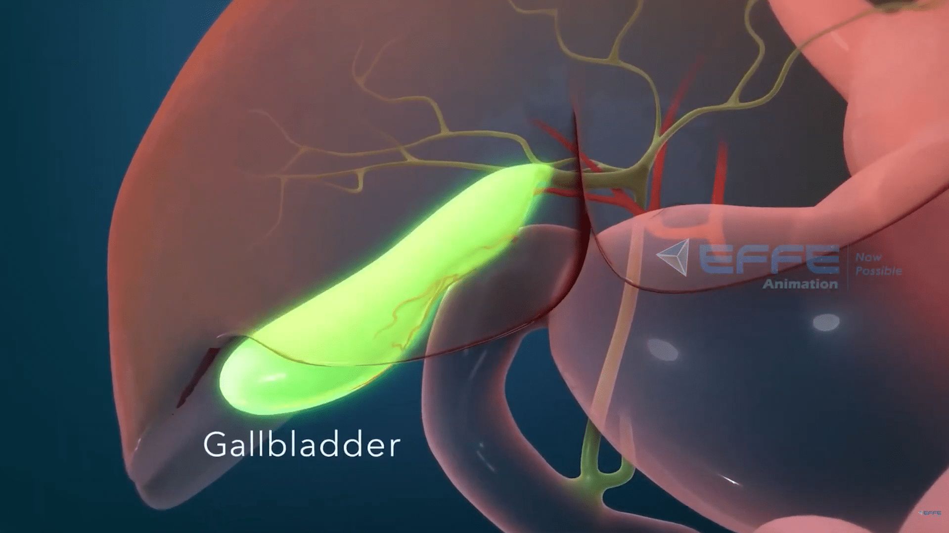 Laparoscopic Surgery Animation