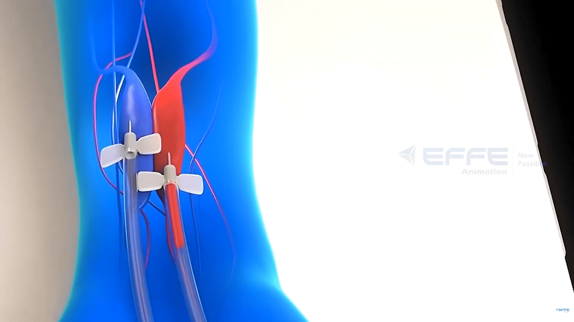 renal support devices 