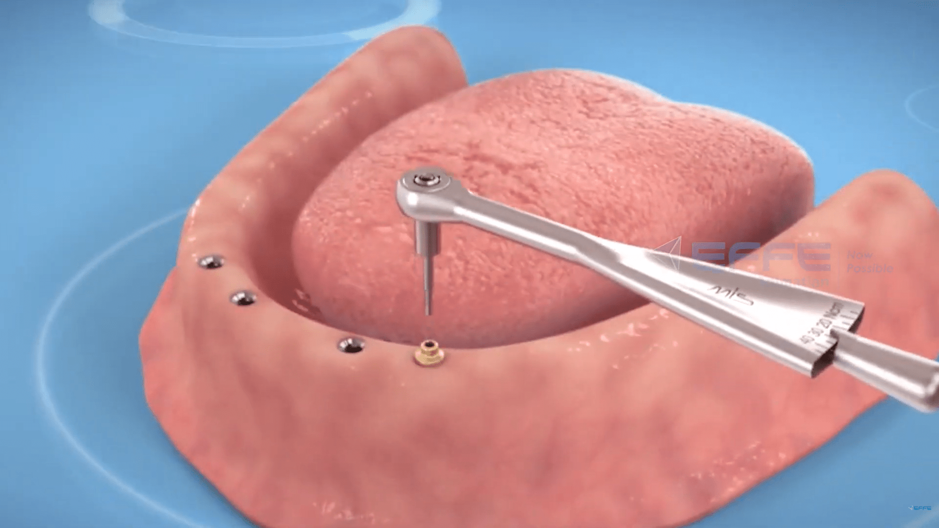 Dental Implants device 