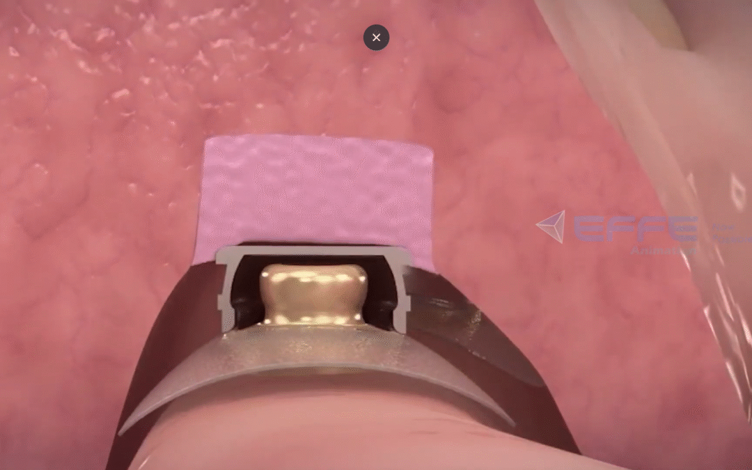 Dental Implants Device – Advanced 3D Animation for Patient Education & Training