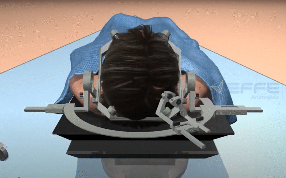 Neuro-Navigation System – Advanced Brain Surgery Device 3D Animation
