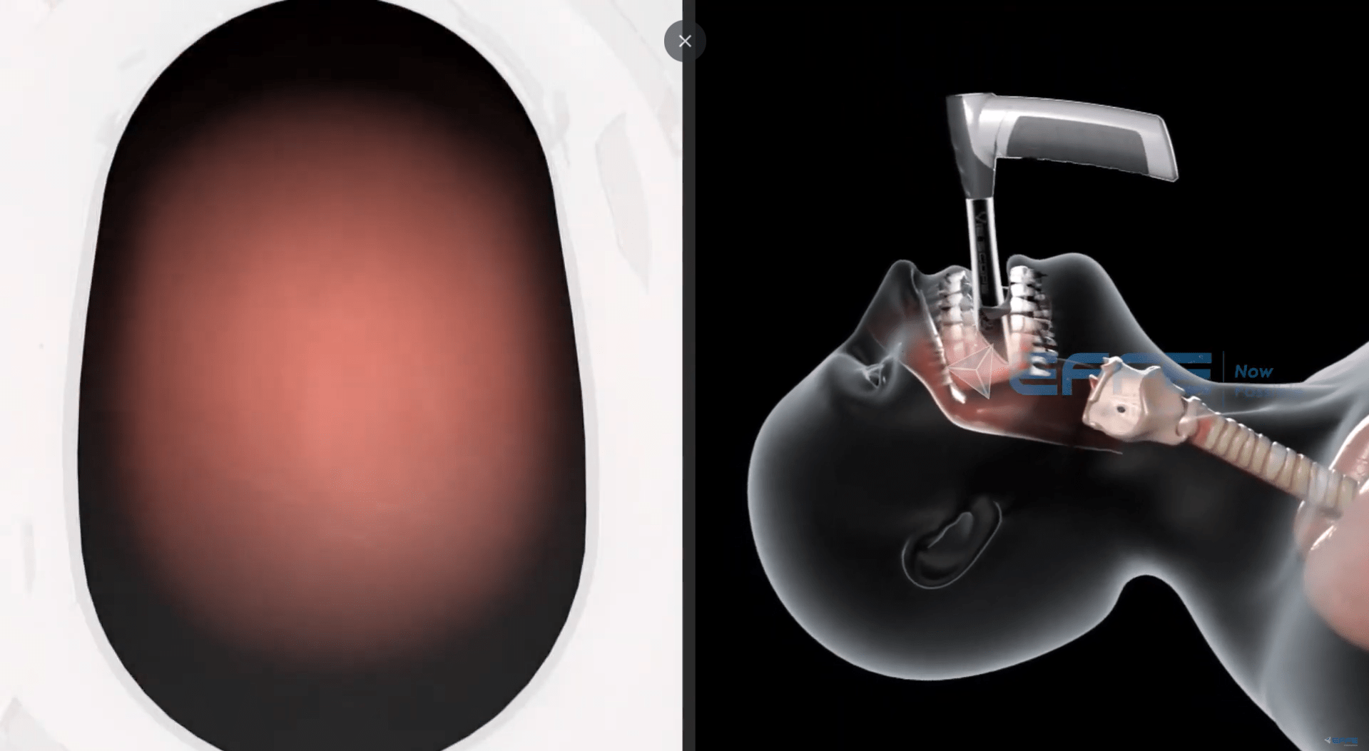 bio medical device animation
