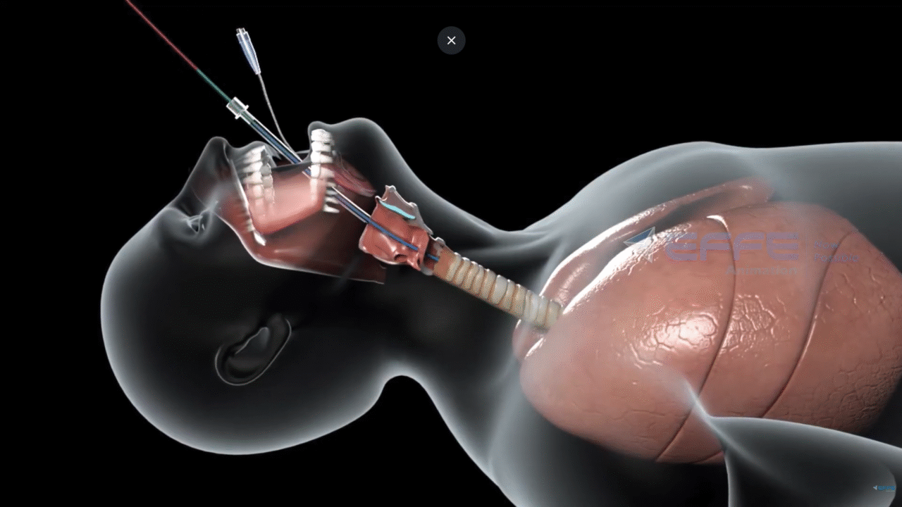 Biomedical Device Animation Services | 3D Medical Videos