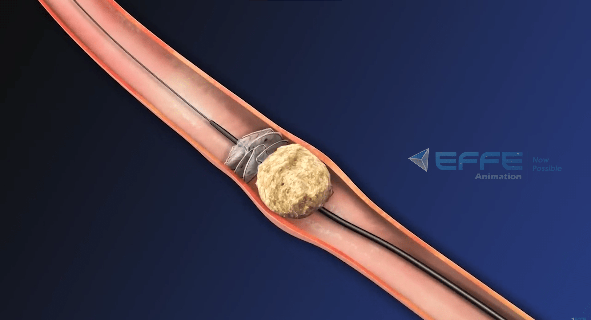 Urologic Surgery animation
