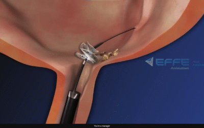 3D Medical Animation for Urologic Surgery Education | 3d Medical Animation