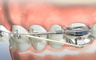Dental Animated Videos for Orthodontic Treatment & Patient Education