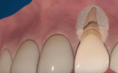 Dental Surgery Animation: Visualizing Oral Procedures Step by Step