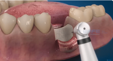 Dental Surgery Animation: Visualizing Oral Procedures Step by Step - 3D ...