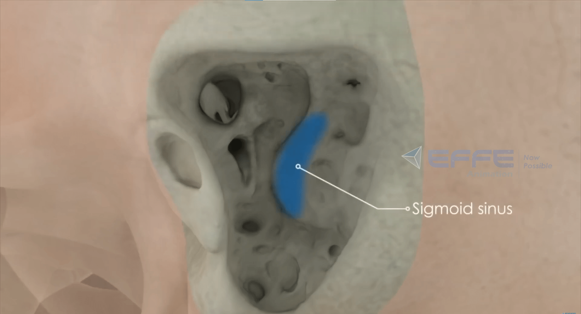 Otolaryngologic Surgery animation 