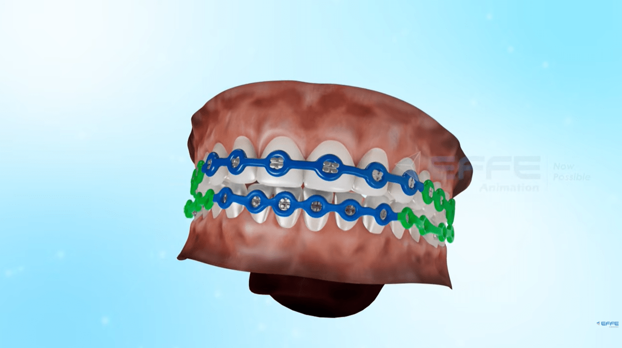orthodontic 3D animation